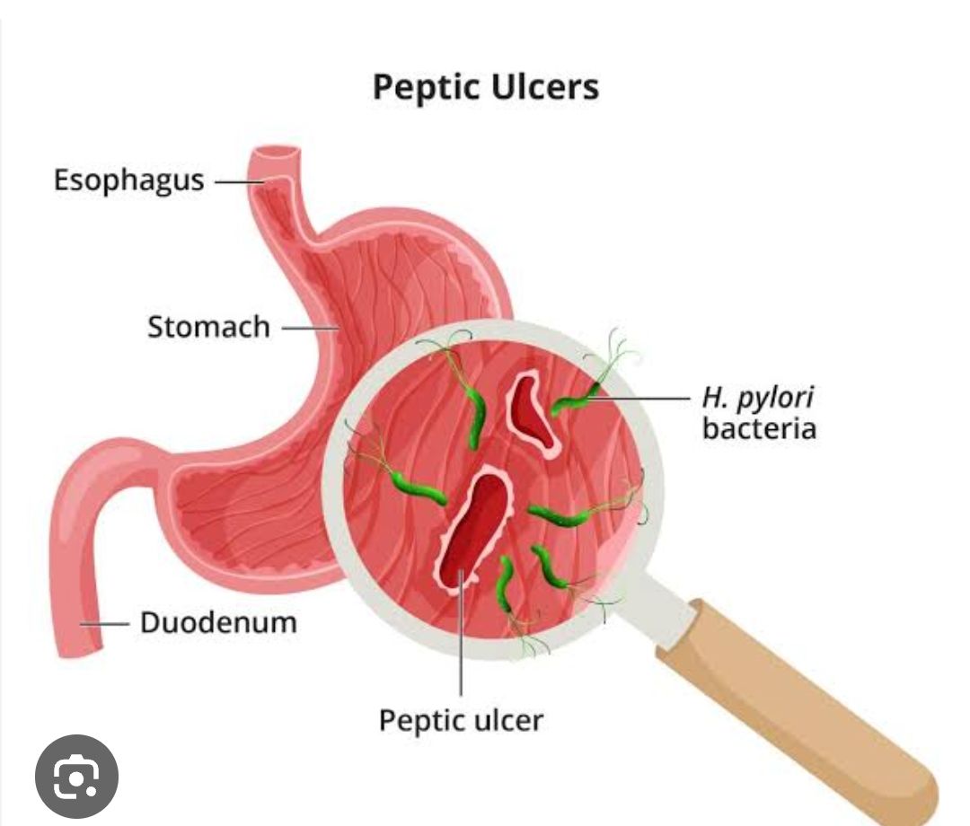 what-is-ulcer-klyhealth-in